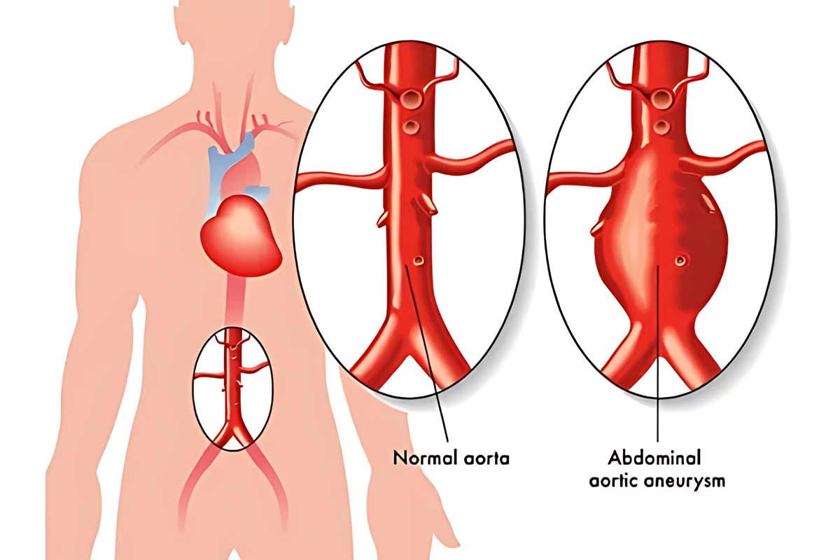 Abdominal Aort Anevrizması