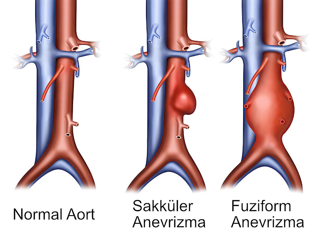 Aort Anevrizması (Aort Damarı Genişlemesi) Nedir, Aort Anevrizması Belirtisi ve Tedavisi nelerdir