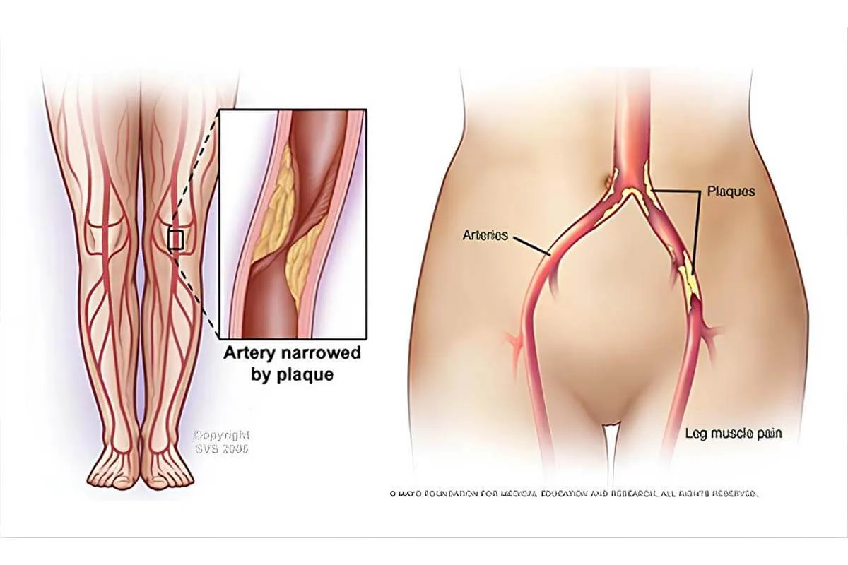 Bacak Damarı Tıkanıklığı (Periferik Arter Hastalığı) Nedir?