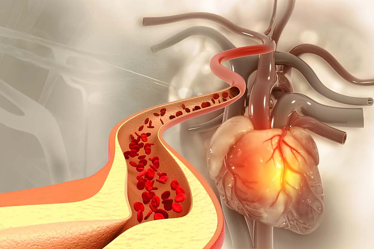 Kolesterol yüksekliği (hiperlipidemi) nedir? Hiperlipidemi (kolesterol yüksekliği) belirtileri ve tedavisi nasıldır?