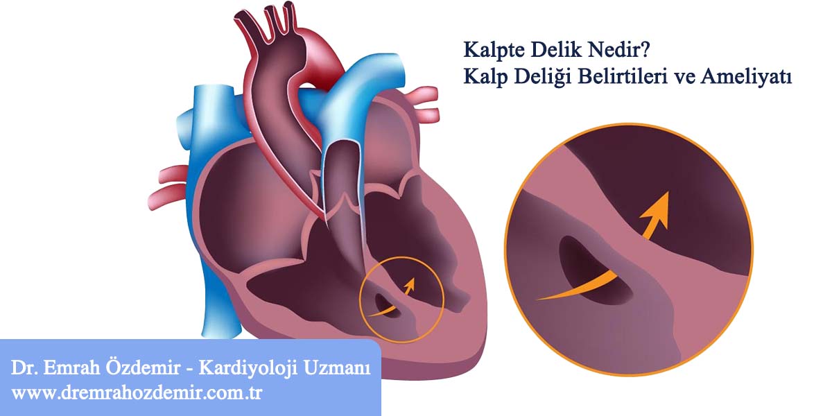 Kalpte Delik Nedir? Kalp Deliği Belirtileri Nelerdir?